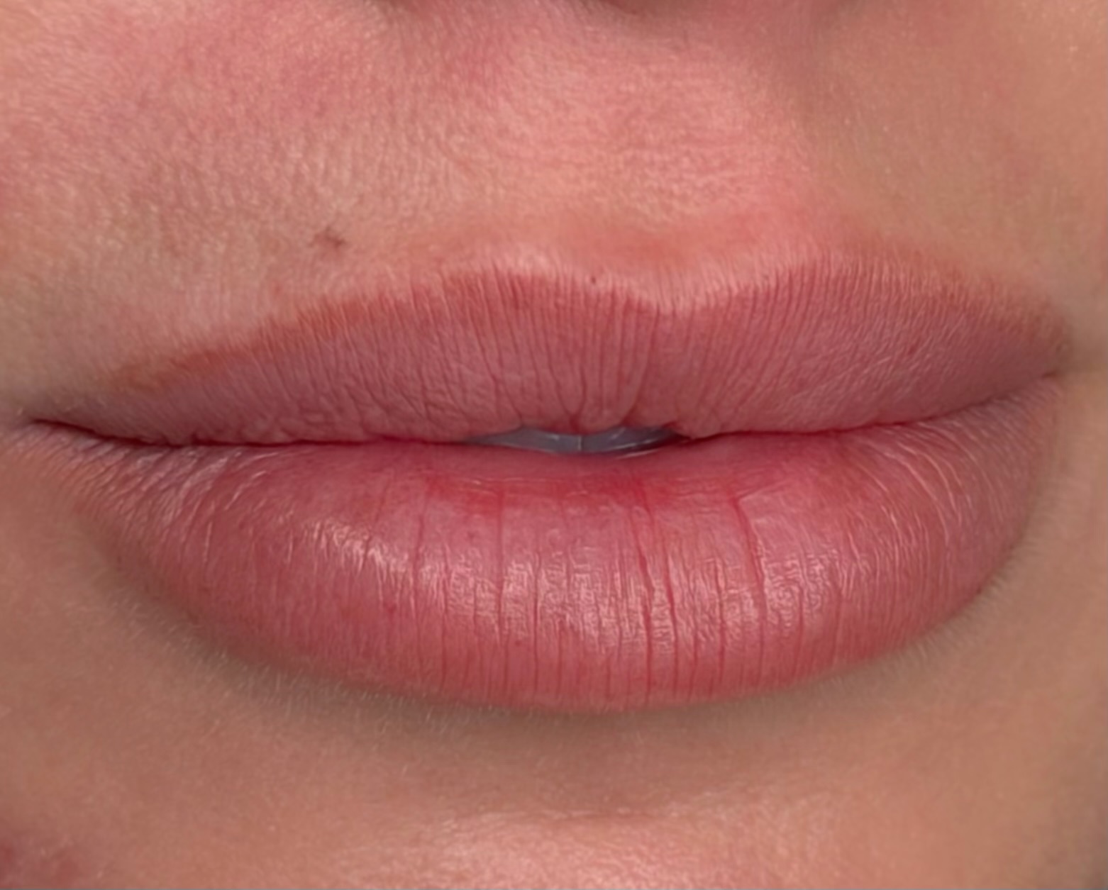 Lips before a second lip blush treatment