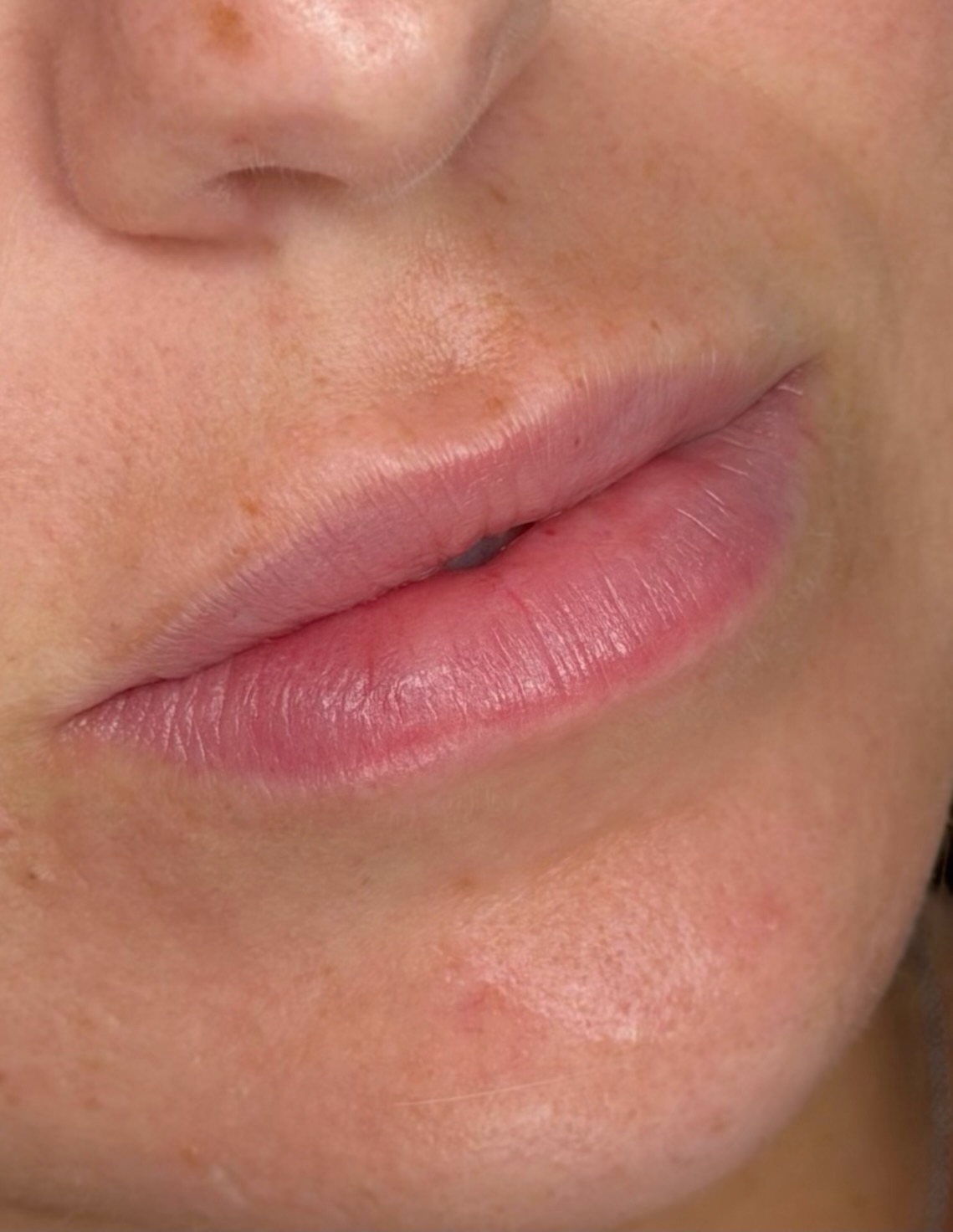 Lips before lip blush