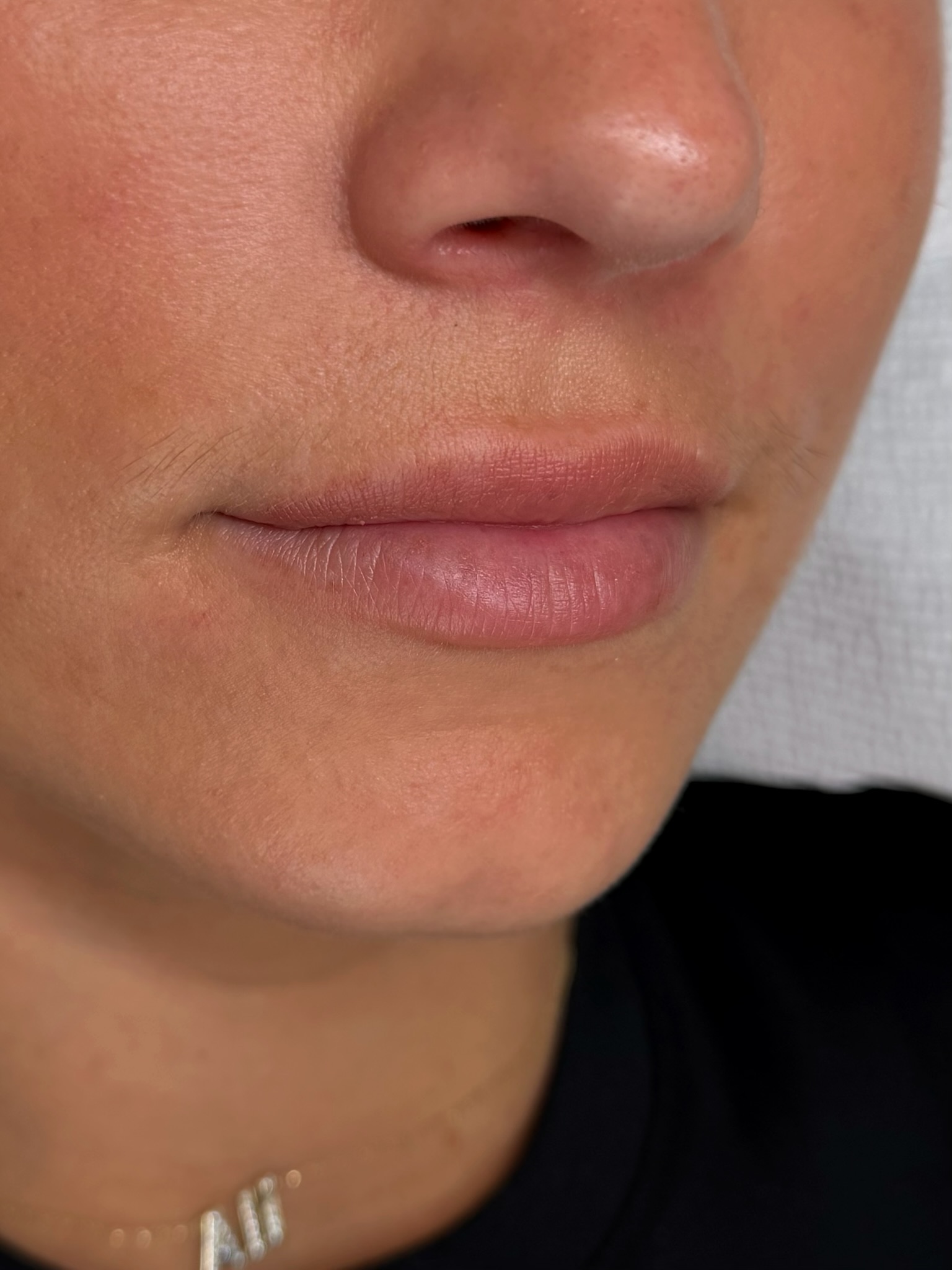 Client lips before lip blush