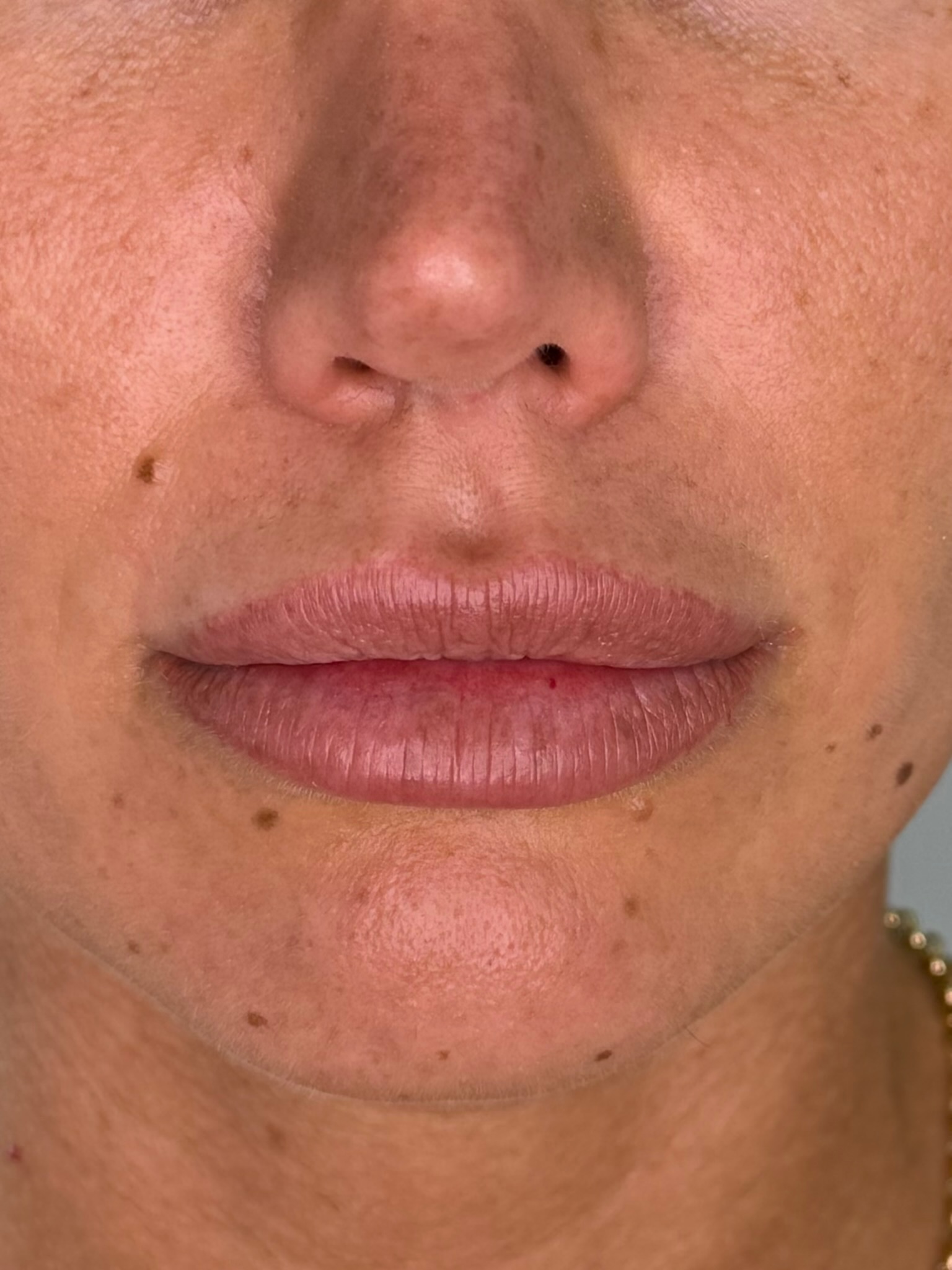 Lips before lip blush